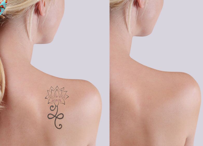 Laser Tattoo Removal - La Fameux Derma